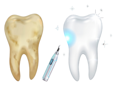 Teeth Whitening