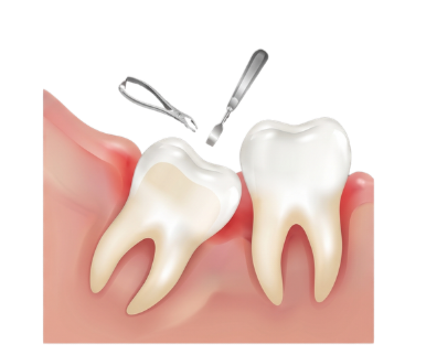 Wisdom Teeth